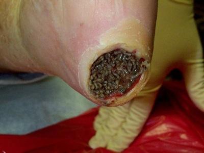 most disgusting infections