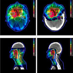 radiation oncology